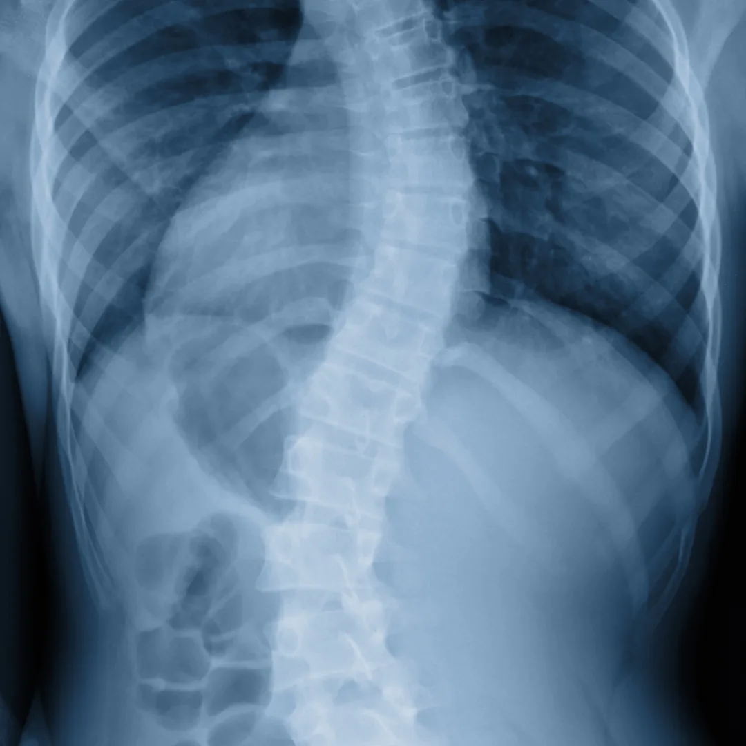 Preventing and Treating Scoliosis Pain with Our Bainbridge Island Chiropractor